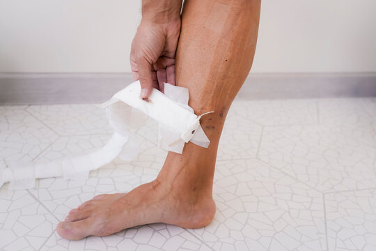 Removal of bandages and dressings after laser coagulation of veins on the shin and calf of men's legs