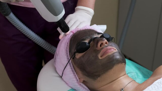 Carbon Laser Peel Facial Treatment in Beauty Clinic