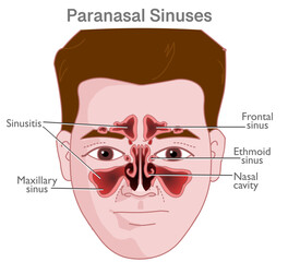 Paranasal air sinuses are air filled spaces present in the bones surrounding the nasal cavity. Frontal, ethmoid, sphenoid and maxilla. Illustration vector © LuckySoul