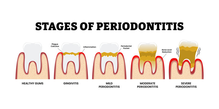 Stages of periodontitis stages. Steps of chronic bacterial gum infection process. Labeled healthy gums, gingivitis, mid, moderate, severe. Plague calculus. Inflammation teeth lose. Periodontal disease
