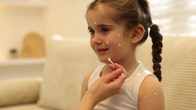 Mother applying cream onto skin of her daughter with chickenpox at home, closeup