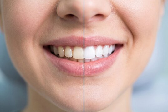 Split screen showing a woman smile before and after teeth whitening treatment