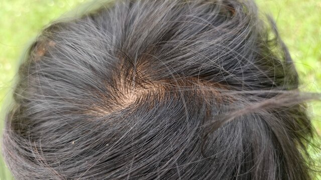 Close-up top view of human hair whorl showing natural scalp and black hair texture. Perfect for hair care topics, dermatology, alopecia awareness, genetics, and medical or cosmetic education