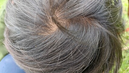 Fototapeta premium Close-up top view of human hair whorl showing natural scalp and black hair texture. Perfect for hair care topics, dermatology, alopecia awareness, genetics, and medical or cosmetic education