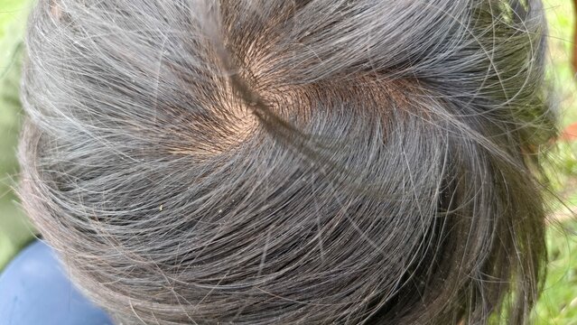 Close-up top view of human hair whorl showing natural scalp and black hair texture. Perfect for hair care topics, dermatology, alopecia awareness, genetics, and medical or cosmetic education