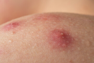 Fototapeta premium Acne skin pimple. Skin problem with inflamed bumps. Irritated skin texture. Close up skin issue.