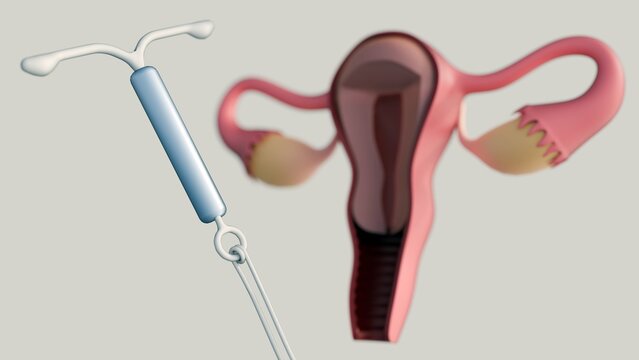 A 3D rendering of a cross-sectional view of the female reproductive system featuring an Intrauterine Device or IUD. An IUD acts as a long-acting reversible contraceptive (LARC).