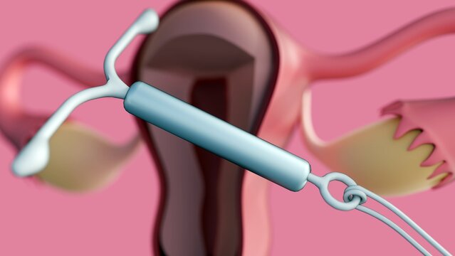 A 3D rendering of a cross-sectional view of the female reproductive system featuring an Intrauterine Device or IUD. An IUD acts as a long-acting reversible contraceptive (LARC).
