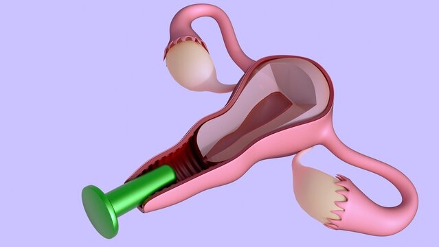 A 3d rendering of one dilator is inserted into the vaginal canal of the anatomical diagram to demonstrate its function. Vaginal dilators are medical devices used to gently stretch the vaginal tissues.