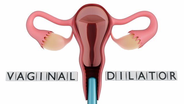 A 3d rendering of one dilator is inserted into the vaginal canal of the anatomical diagram to demonstrate its function. Vaginal dilators are medical devices used to gently stretch the vaginal tissues.