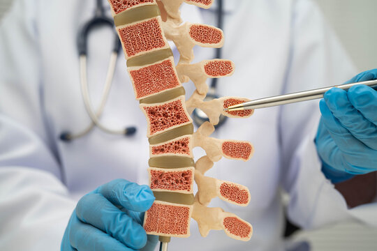 Doctor holding osteoporosis in back bone model for treatment medical in orthopedic department.