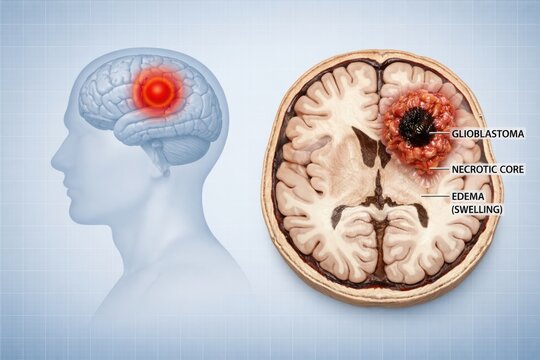Glioblastoma Brain Tumor Illustration with Necrotic Core and Edema Swelling.