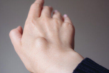Female right back hand with ganglion cyst on the dorsum,  fluid-filled bump associated with a joint or tendon sheath, close-up view, selected focus.