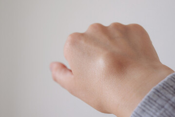 Female right back hand with ganglion cyst on the dorsum,  fluid-filled bump associated with a joint or tendon sheath, close-up view, selected focus.