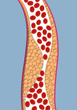 Atherosclerosis, illustration