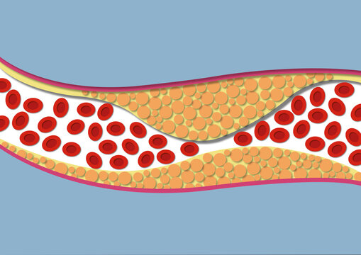 Atherosclerosis, illustration