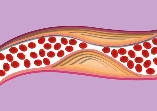 Atherosclerosis, illustration