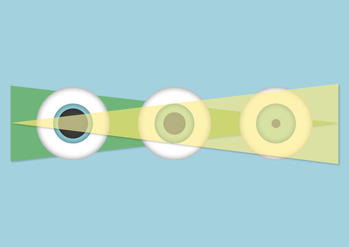 Pupillary light reflex, illustration