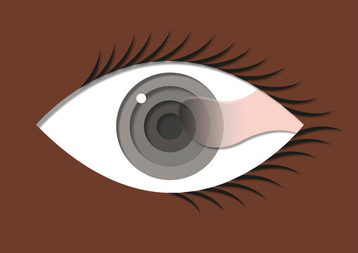 Pterygium, illustration