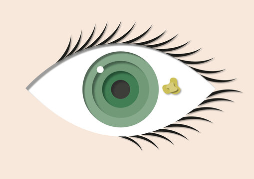 Pinguecula, illustration