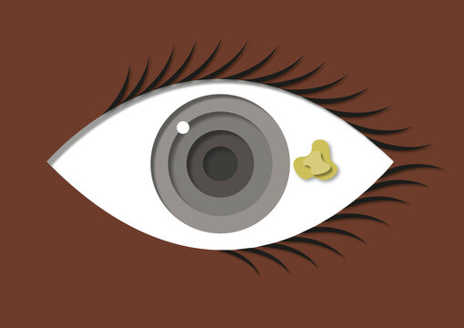 Pinguecula, illustration