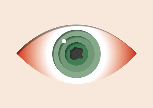 Uveitis, illustration