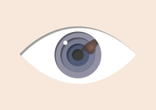 Eye melanoma, illustration