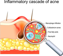 Inflammatory cascade of acne. © designua