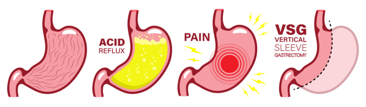 Stomach set acid reflux pain vsg vector illustration Digestive Issues, Human stomach