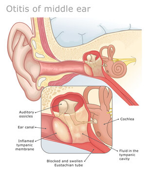 Medical diagram of otitis media showing fluid and pressure buildup in the middle ear. Ear Anatomy Series.