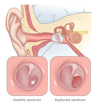 Ruptured eardrum illustration. Diagram showing a hole in the eardrum due to infection or trauma. Ear Anatomy Series.