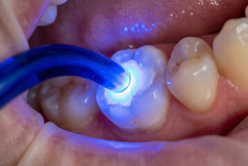 Fototapeta premium Dentist using blue UV curing light lamp on composite resin filling in patient molar tooth