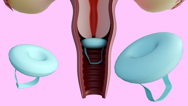 A 3d rendering of cross-section of the female reproductive system with a contraceptive sponge. It physically blocks the cervix so sperm can't get into the uterus.