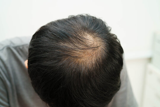 Bald in the middle head and begin no loss hair glabrous of mature man.