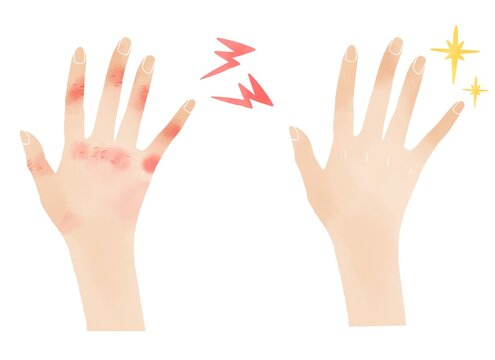 水彩風のハンドケア素材 しもやけ改善前後のビフォーアフター挿絵