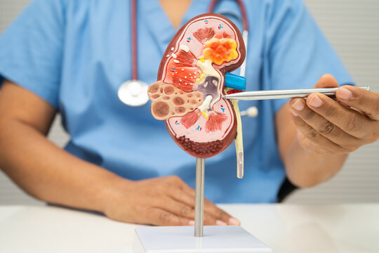 Chronic kidney disease, doctor with model for treatment urinary system, urology, Estimated glomerular filtration rate eGFR.