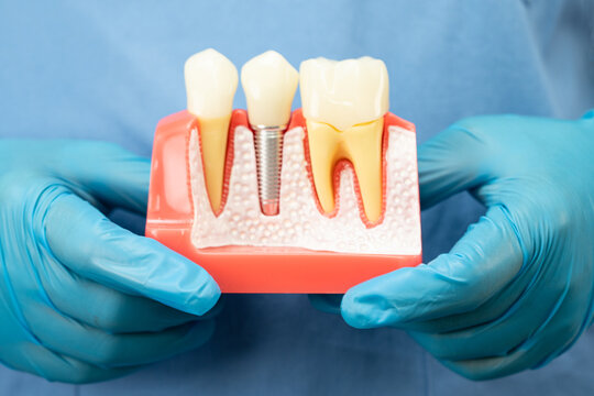 Asian dentist holding dental implant, artificial tooth roots into jaw, root canal of dental treatment, gum disease, teeth model for dentist.
