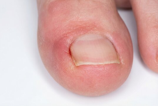 Ingrown toenail with inflamed skin on a human toe