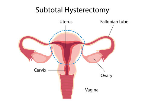 Subtotal Hysterectomy. Surgical removal of the uterus. Female anatomy. Vector Medical diagram for gynecology. 
