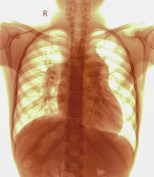 X-ray of human chest. Pulmonary consolidation (right). Cardiomegaly. 