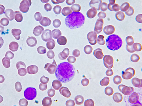 Acute leukemia. WBC grossly increased in number, left shift, atypical looking large mononuclear cells with nucleoli. 