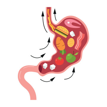 An illustration of a stomach full of unhealthy food, including hamburgers, sweets, and fruit. Conceptual representation of the consequences of poor diet or overeating. Stomach diseases.