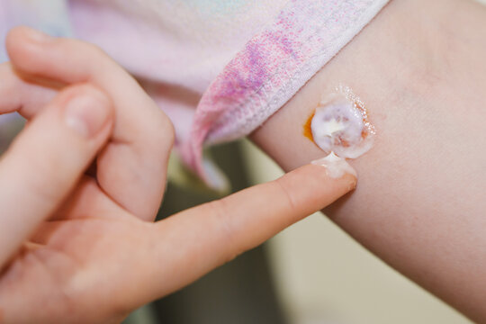 Treatment of ringworm lesion on skin surface during care session