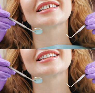 Dental transformation before and after correction restoration of chipped front broken tooth of Female