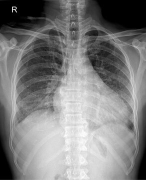 Chest X-ray showing central venous catheter placement with cardiomegaly