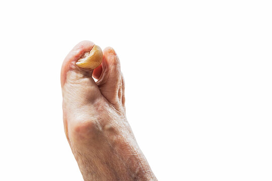Foot with deformed yellow nail. Onychogryphosis or rams horn nail. Medical and health issue concept for diagnosis, treatment.