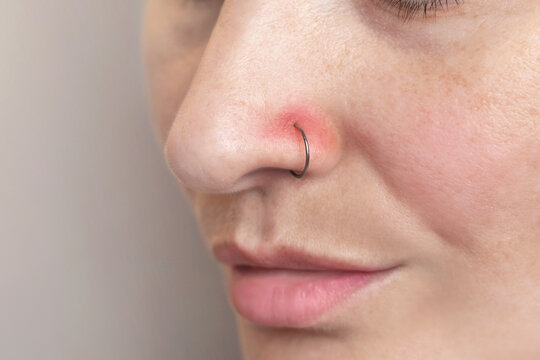 A woman's nose piercing. Inflamed piercing, nose after piercing. Red nose piercing site. Close up photo