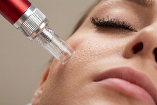 Close-up of professional microneedling beauty treatment on woman cheek using a pen device for skin rejuvenation in a clinic spa