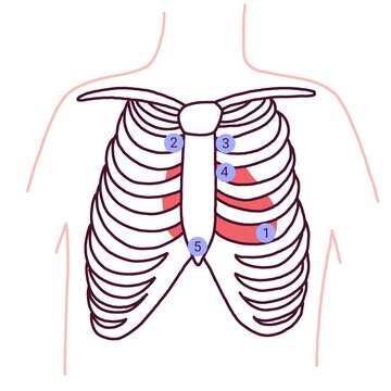 Medical illustration showing heart auscultation points on the chest.