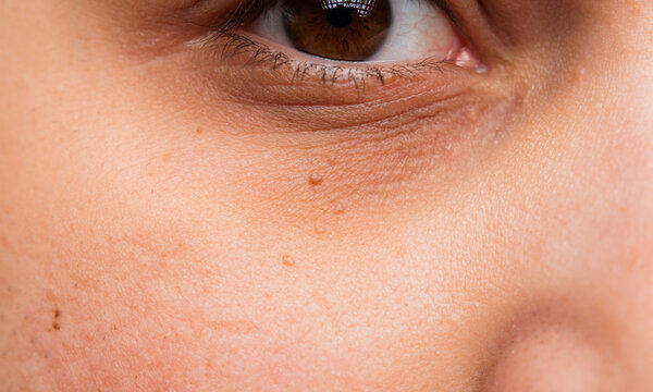 Cloe up of syringomas under a eye. Milia on a male face